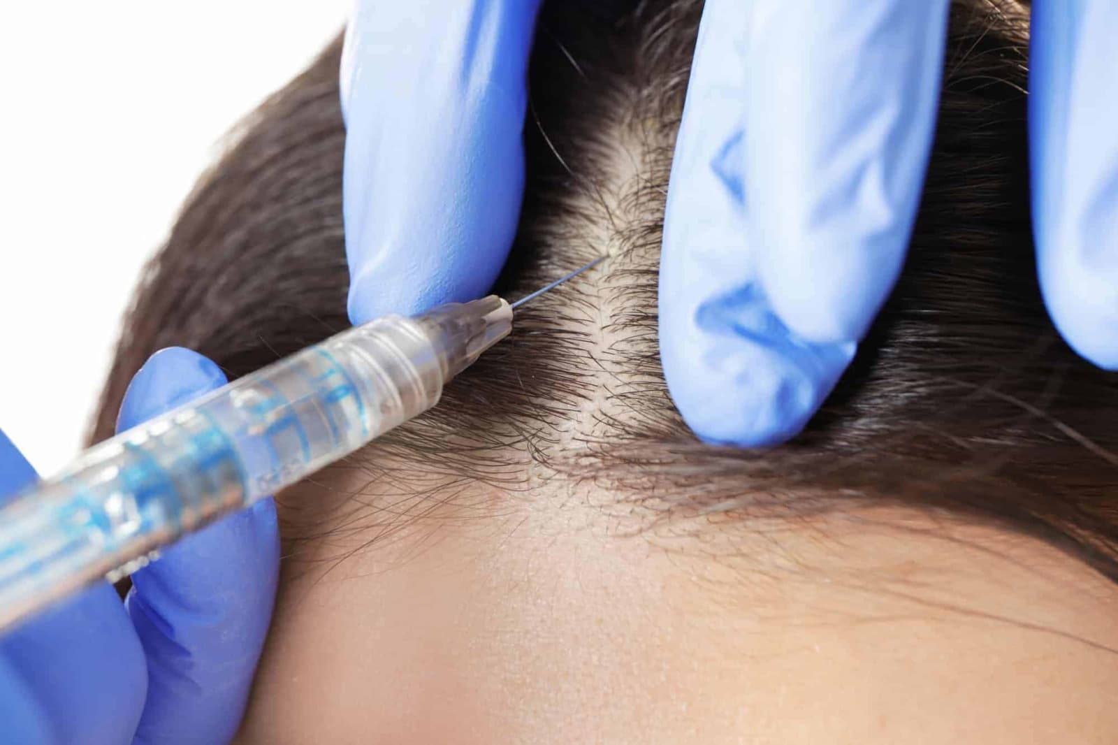 Leading Hair Transplant UK Clinic – Trusted Experts in Hair Restoration