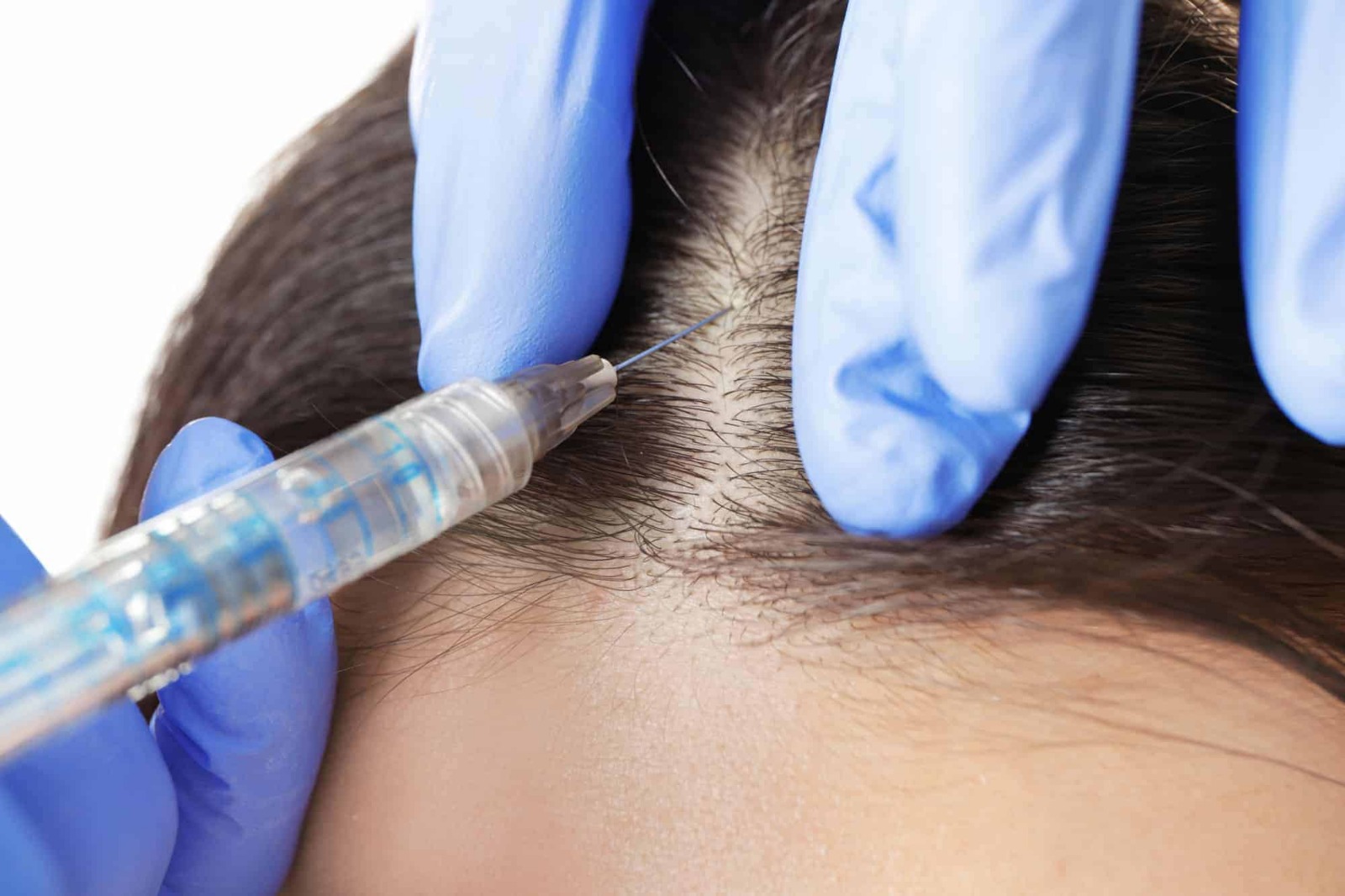 Hair Transplant Turkey – Safe, Effective, and Pain-Free Procedures