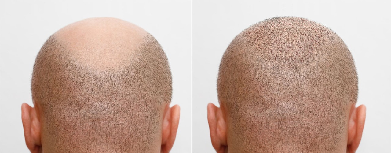 Comparing Hair Transplant London Costs – Get the Facts